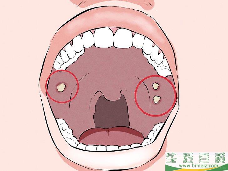 怎么识别口腔癌的症状