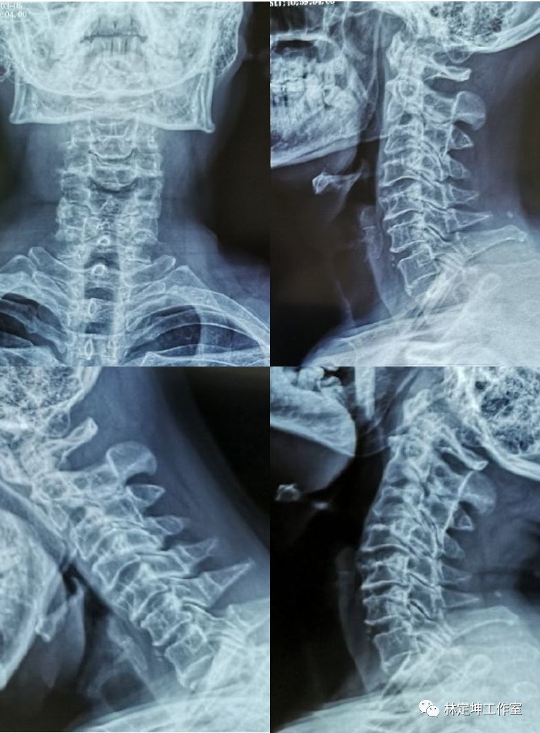 他的颈椎x光照片,显示颈椎骨质轻度增生,但椎节稳定,无发育性椎管狭窄