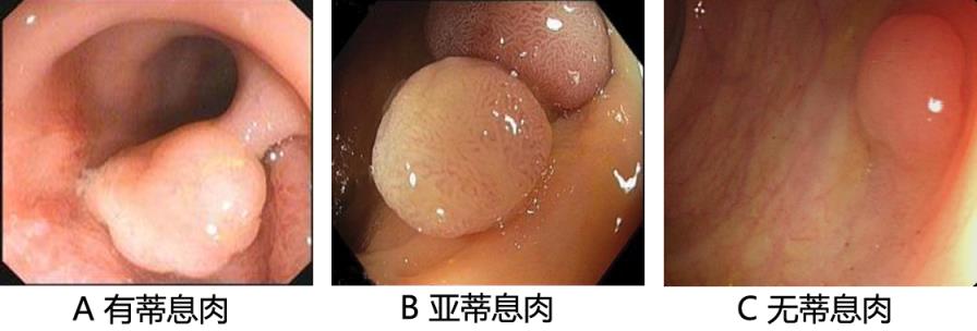 什么是大肠息肉?如何判断大肠息肉是良性还是恶性?