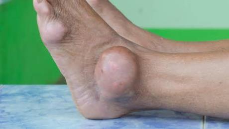 脚踝肿胀的原因有哪些?