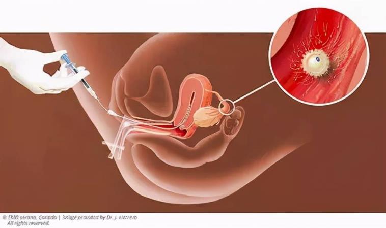 宫颈活检过程步骤图片