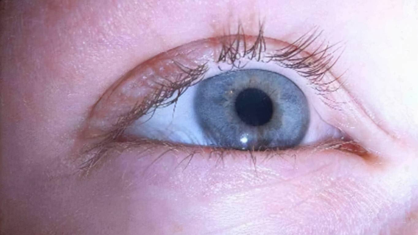 青光眼是什么症状(青光眼5大症状)